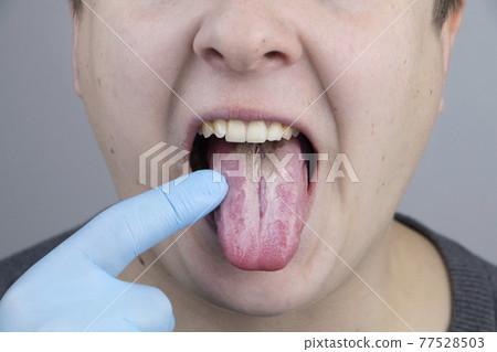 White curd on the tongue. A physician or gastroenterologist examines a man tongue. Patient has poor oral hygiene or a symptom of illness White curd on the tongue. A physician or gastroenterologist examines a man tongue. Patient has poor oral hygiene or a symptom of illness 77528503