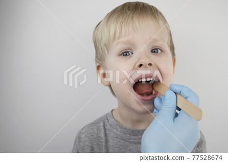 An otolaryngologist examines a child's throat with a wooden spatula. A possible diagnosis is inflammation of the pharynx, tonsils or pharyngitis. The concept of treatment and prevention of childhood An otolaryngologist examines a child's throat with a wooden spatula. A possible diagnosis is inflammation of the pharynx, tonsils or pharyngitis. The concept of treatment and prevention of childhood 77528674