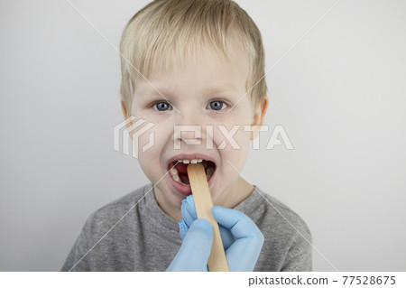 An otolaryngologist examines a child's throat with a wooden spatula. A possible diagnosis is inflammation of the pharynx, tonsils or pharyngitis. The concept of treatment and prevention of childhood An otolaryngologist examines a child's throat with a wooden spatula. A possible diagnosis is inflammation of the pharynx, tonsils or pharyngitis. The concept of treatment and prevention of childhood 77528675