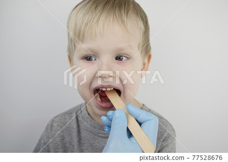 An otolaryngologist examines a child's throat with a wooden spatula. A possible diagnosis is inflammation of the pharynx, tonsils or pharyngitis. The concept of treatment and prevention of childhood An otolaryngologist examines a child's throat with a wooden spatula. A possible diagnosis is inflammation of the pharynx, tonsils or pharyngitis. The concept of treatment and prevention of childhood 77528676