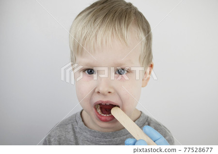 An otolaryngologist examines a child's throat with a wooden spatula. A possible diagnosis is inflammation of the pharynx, tonsils or pharyngitis. The concept of treatment and prevention of childhood 77528677