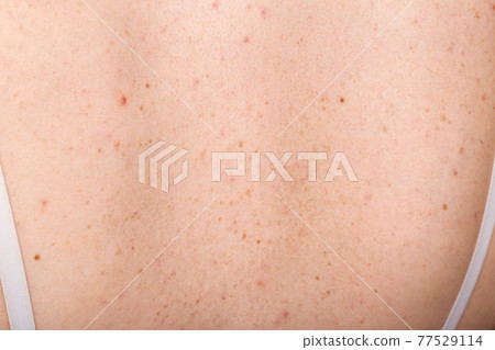 Pigmented spots and pimples on the skin of the girl's back. Dermatology and allergy concept, close-up Pigmented spots and pimples on the skin of the girl's back. Dermatology and allergy concept, close-up 77529114