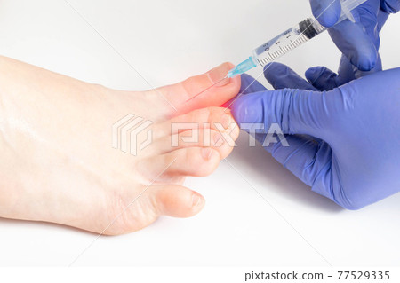 The doctor makes an injection between the toes against hyperhidrosis sweating. Unpleasant foot odor treatment concept, cosmetology 77529335