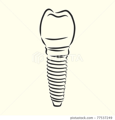 Vector illustration. sketches, dental implants. dental implant, vector sketch illustration 77537249