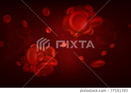 Blood clots, thrombus or embolus with coagulated erythrocytes. Blood clots, thrombus or embolus with coagulated erythrocytes. 77581393