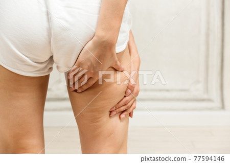 大腿脂肪/年輕女子 大腿脂肪/年輕女子 77594146