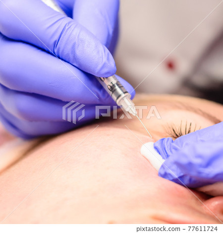 Miliums on the face, removal of hardened and mature milia by a beautician. Miliums on the face, removal of hardened and mature milia by a beautician. 77611724