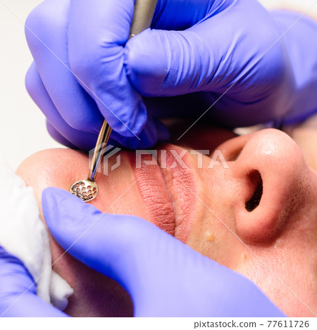 The beautician cleanses the patient's skin with a spoon uno, moisturizing, cleansing and skin care. 77611726