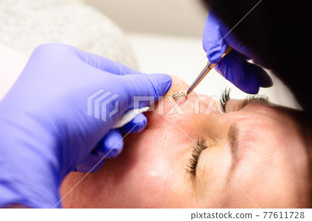 Mechanical cleansing of the face with a spoon uno, removing grease and blackheads. 77611728