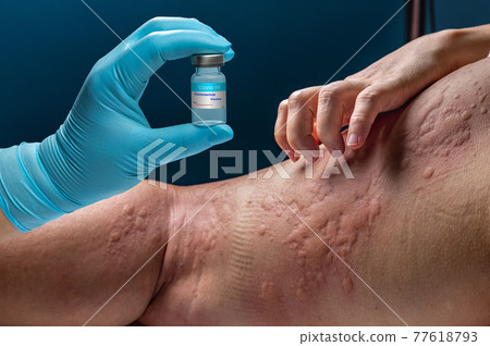 vaccine covid 19 allergies symptom in elderly after vaccination. vaccine covid 19 allergies symptom in elderly after vaccination. 77618793