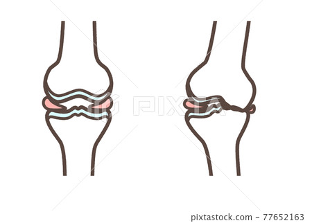 Knee joint illustration 77652163