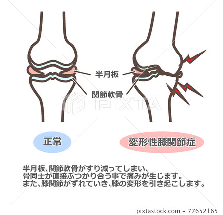 Knee osteoarthritis with commentary 77652165