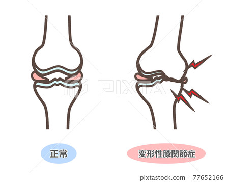 Illustration of knee osteoarthritis 77652166