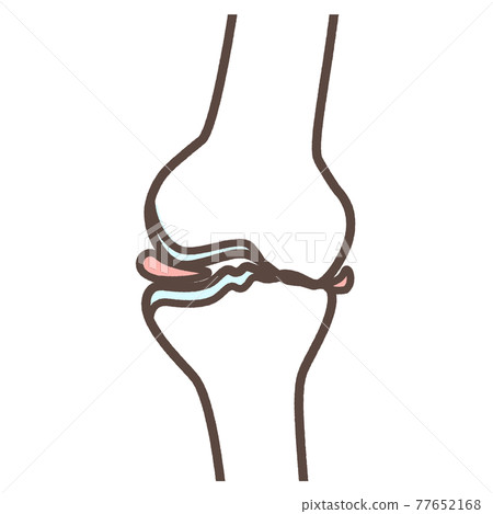 膝關節骨關節炎的插圖 膝關節骨關節炎的插圖 77652168