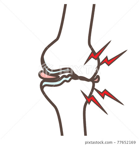 Illustration of knee osteoarthritis 77652169