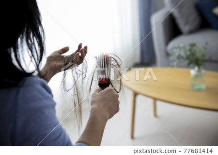 Hair loss image 77681414