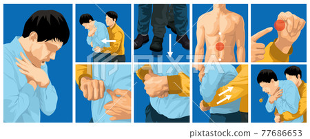 Heimlich maneuver. First aid for airway obstruction in adults. 77686653