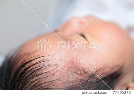 Infant eczema in newborns 77695270
