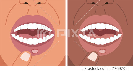 Vector illustration canker sore, aphthous ulcer on the lip, stomatitis. 77697061