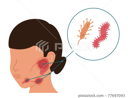 A woman with bacterial inflammation of the salivary glands. Vector illustration of sialolithiasis. A woman with bacterial inflammation of the salivary glands. Vector illustration of sialolithiasis. 77697093