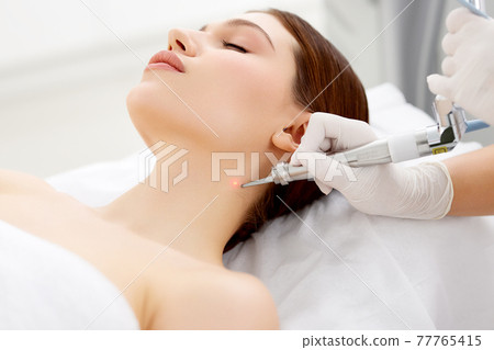 Cosmetologist removing mole with laser machine Cosmetologist removing mole with laser machine 77765415