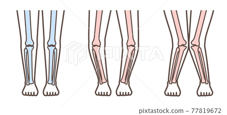 Knee osteoarthritis illustrated 77819672