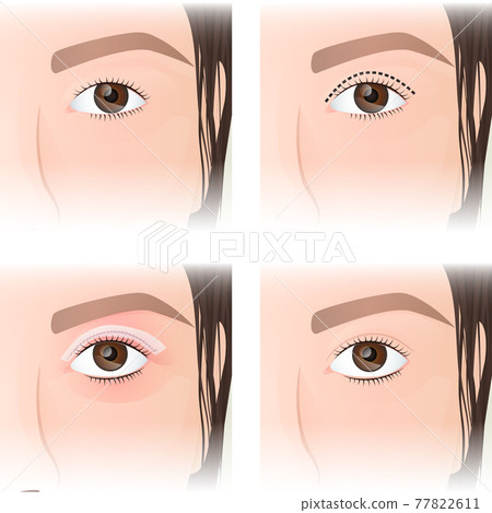 East Asian blepharoplasty, before and after images 77822611