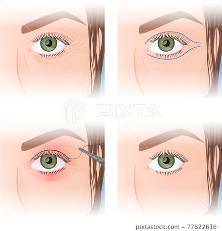 blepharoplasty, upper eyelid plastic, before and after images 77822616