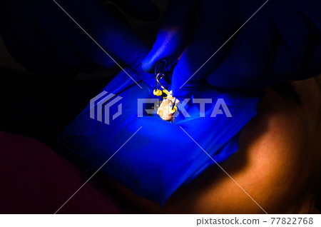 Installation of a rubber dam by a dentist, sterile and modern dental treatment. 77822768