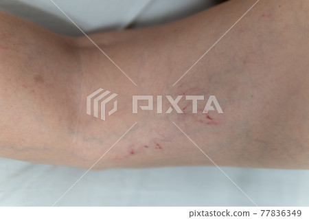 removal of blood vessels by laser vessel venous disease, varicose problem patient close vein, cutout risk enlarged, aesthetic telangiectases physical 77836349