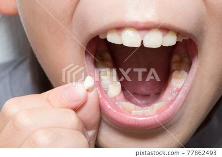 Missing deciduous teeth Regeneration of deciduous teeth 77862493