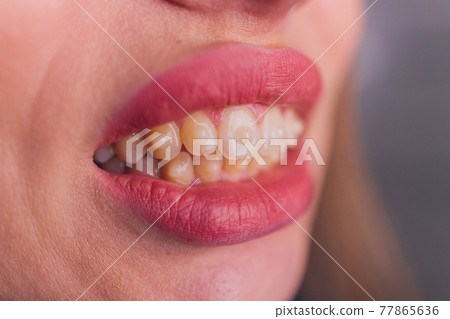 Brasket system in a girl's smiling mouth, macro photography of teeth. large face and painted lips. Braces on the teeth of a girl who smiles. 77865636