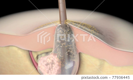 Acne And Pimples, Stages Of Development, Graphic Animation Acne And Pimples, Stages Of Development, Graphic Animation 77936445