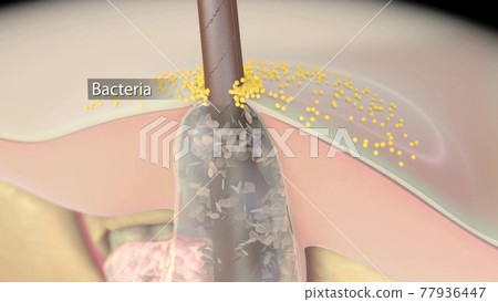 Acne And Pimples, Stages Of Development, Graphic Animation Acne And Pimples, Stages Of Development, Graphic Animation 77936447