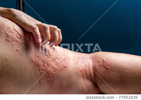vaccine covid 19 allergies symptom in elderly after vaccination. vaccine covid 19 allergies symptom in elderly after vaccination. 77952836