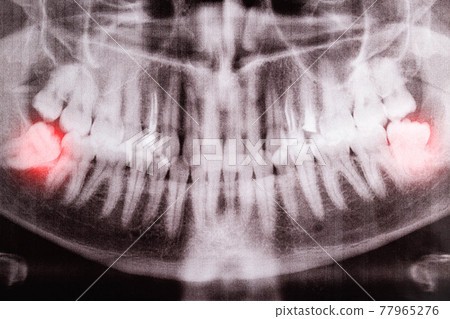 Impacted wisdom teeth on an X-ray picture with an inflamed cyst neoplasm. Removal of wisdom teeth in dentistry. Pericoronaritis Impacted wisdom teeth on an X-ray picture with an inflamed cyst neoplasm. Removal of wisdom teeth in dentistry. Pericoronaritis 77965276