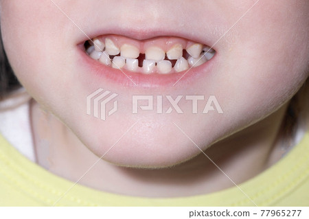 little girl with open mouth and baby teeth. The concept of proper care for the oral cavity and baby teeth in children, close-up little girl with open mouth and baby teeth. The concept of proper care for the oral cavity and baby teeth in children, close-up 77965277