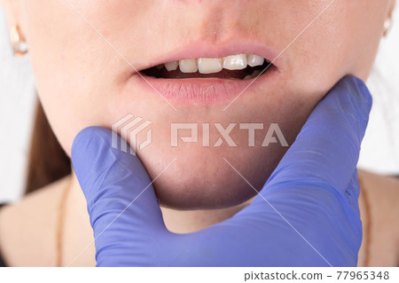 The doctor checks the jaw of a girl who has a malocclusion of her mouth and teeth, close-up, orthodontist The doctor checks the jaw of a girl who has a malocclusion of her mouth and teeth, close-up, orthodontist 77965348