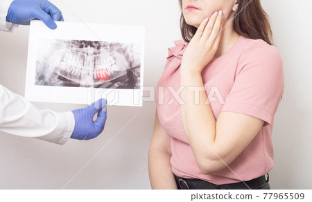 Dentist surgeon shows the patient s wisdom tooth on x-rays. Dental surgery concept, pain when teething wisdom tooth 77965509