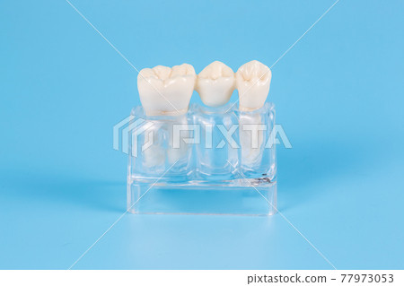 Dental crowns, imitation of a dental prosthesis of a dental bridge for one tooth 77973053