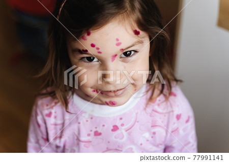Toddler girl with chickenpox measles on the body. Varicella virus childhood contagious disease 77991141