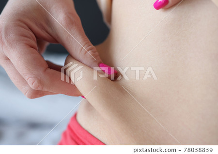 Woman shows fatty cellulite fold on her side 78038839