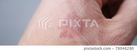 Closeup of burn stain on mans hand 78048280