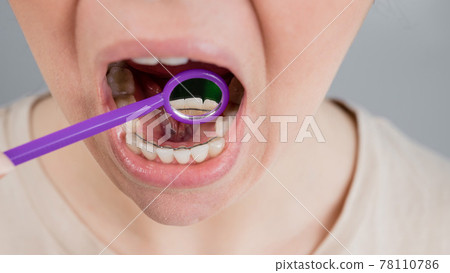 Close-up portrait of a woman with internal braces and a dental mirror. The girl corrects the bite Close-up portrait of a woman with internal braces and a dental mirror. The girl corrects the bite 78110786