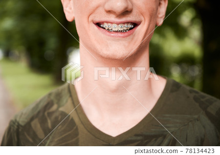 Cheerful young man showing teeth with braces. Cheerful young man showing teeth with braces. 78134423