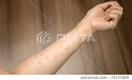 一個女人因為壓力而手臂上有濕疹 78135808