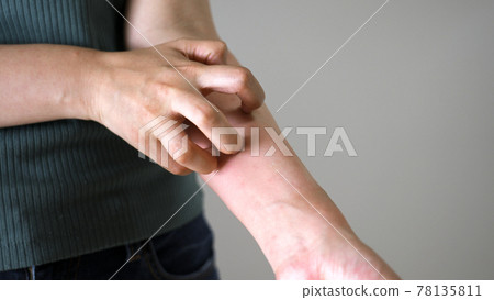 一個女人因為壓力而手臂上有濕疹 一個女人因為壓力而手臂上有濕疹 78135811