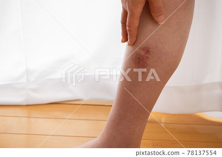 Inside the calf of the foot with symptoms of cellulitis (cellulitis) Inside the calf of the foot with symptoms of cellulitis (cellulitis) 78137554