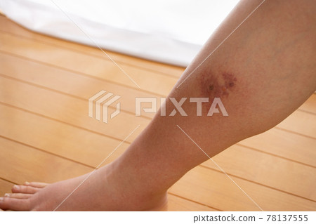 小腿內側有蜂窩織炎（蜂窩織炎）症狀 78137555