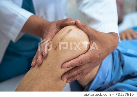 Asian senior or elderly old lady woman patient show her scars surgical total knee joint replacement Suture wound surgery arthroplasty on bed in nursing hospital ward, healthy strong medical concept. 78137610